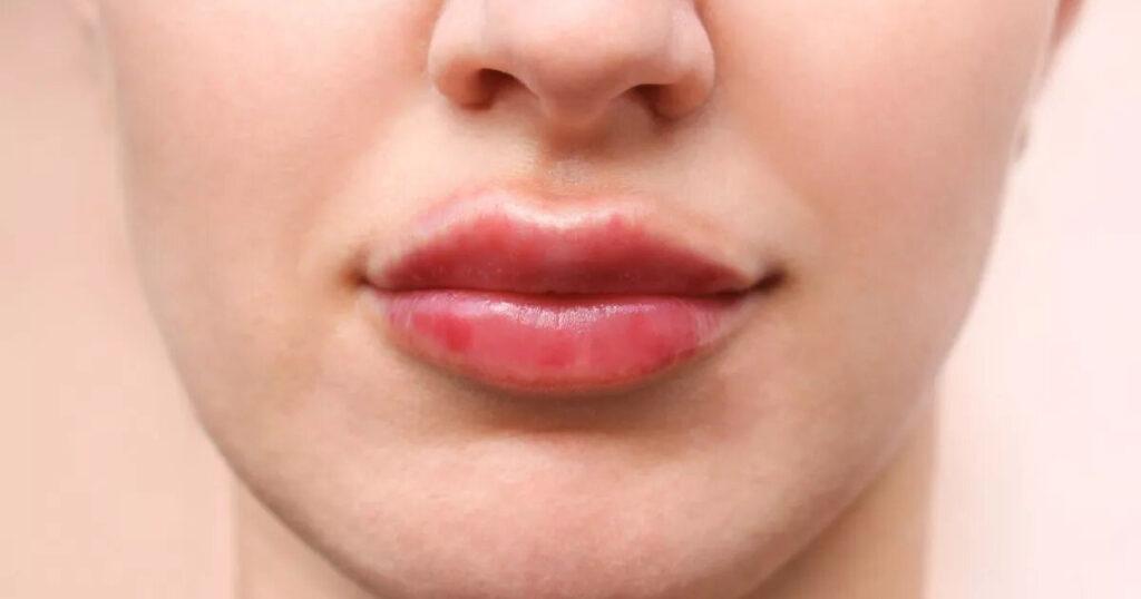 Гиалуроновые усы: как избавиться от последствий неудачной коррекции формы губ